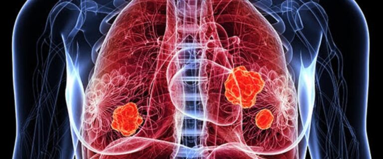 Pulmoner Emboli Nedir?