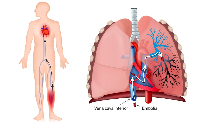 Pulmoner emboli