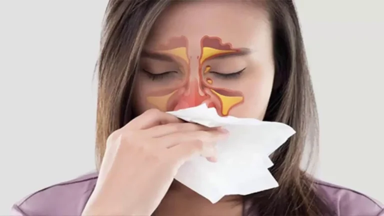 Sinüzit Nedir?